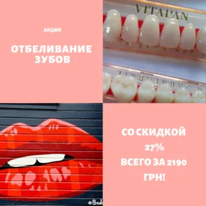 отбеливание зубов акция Киев